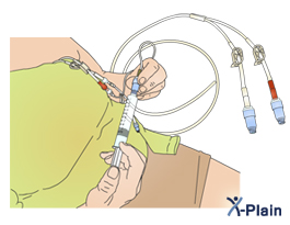 http://patedu.com/health/modules_v2/icons/english/hickman-catheter-care-at-home_ov.jpg