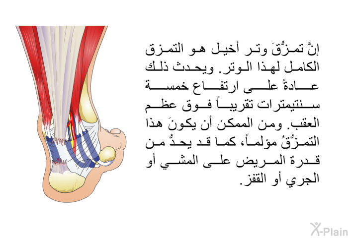 إنَّ تمزُّقَ وتر أخيل هو التمزق الكامل لهذا الوتر. ويحدث ذلك عادة على ارتفاع خمسة سنتيمترات تقريباً فوق عظم العقب. ومن الممكن أن يكونَ هذا التمزُّقُ مؤلماً، كما قد يحدُّ من قدرة المريض على المشي أو الجري أو القفز.