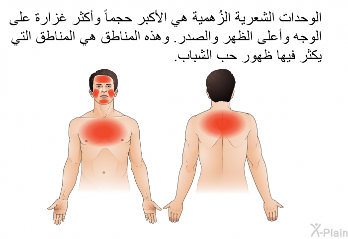 الوحدات الشعرية الزُهمية هي الأكبر حجماً وأكثر غزارة على الوجه وأعلى الظهر والصدر. وهذه المناطق هي المناطق التي يكثر فيها ظهور حب الشباب.