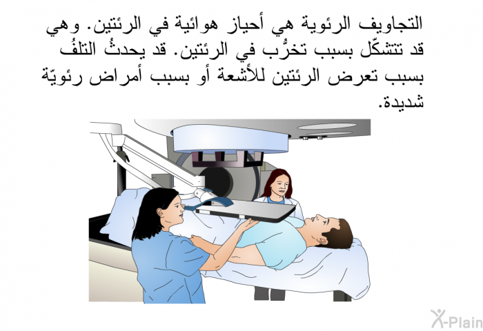 التجاويف الرئوية هي أحياز هوائية في الرئتين. وهي قد تتشكّل بسبب تخرُّب في الرئتين. قد يحدثُ التلفُ بسبب تعرض الرئتين للأشعة أو بسبب أمراض رئويّة شديدة.