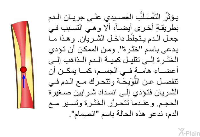 يؤثِّر التَّصَلُّب<B> </B>العَصيدي على جريان الدم بطريقةٍ أخرى أيضاً، ألا وهي التسبب في جعل الدم يتجلَّط داخل الشريان. وهذا ما يدعى باسم "خَثرة". ومن الممكن أن تؤدي الخَثرة إلى تقليل كمية الدم الذاهب إلى أعضاء هامة في الجسم، كما يمكن أن تنفصل عن اللُّوَيحَة وتتحرك مع الدم في الشريان فتؤدي إلى انسداد شرايين صغيرة الحجم. وعندما تتحرَّر الخَثرة وتسير مع الدم، ندعو هذه الحالة باسم "انصِمام".