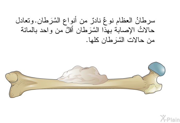 سرطانُ العظام نوعٌ نادرٌ من أنواع السَّرَطان. وتعادل حالاتُ الإصابة بهذا السَّرَطان أقلَّ من واحد بالمائة من حالات السَّرَطان كلها.