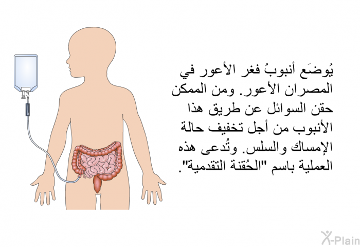 يُوضَع أنبوبُ فغر الأعور في المصران الأعور. ومن الممكن حقن السوائل عن طريق هذا الأنبوب من أجل تخفيف حالة الإمساك والسلس. وتُدعى هذه العملية باسم "الحُقنة التقدمية".