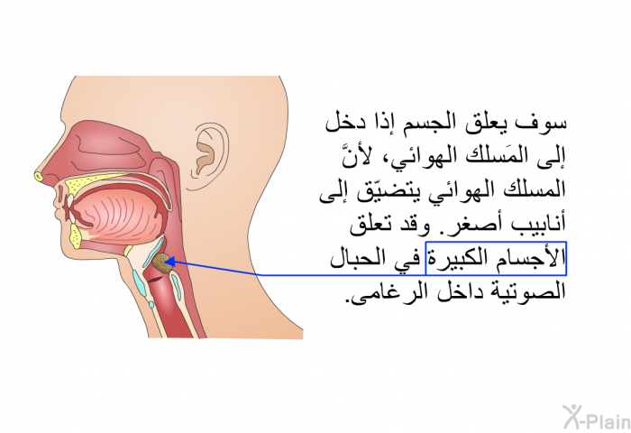 سوف يعلق الجسم إذا دخل إلى المَسلك الهوائي، لأنَّ المسلك الهوائي يتضيّق إلى أنابيب أصغر. وقد تعلق الأجسام الكبيرة في الحبال الصوتية داخل الرغامى.