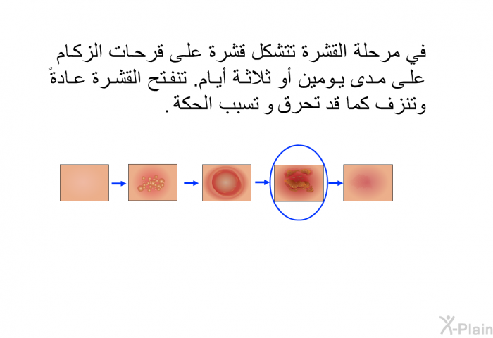 في مرحلة القشرة تتشكل قشرة على قرحات الزكام على مدى يومين أو ثلاثة أيام. تنفتح القشرة عادة وتنزف كما قد تحرق و تسبب الحكة.