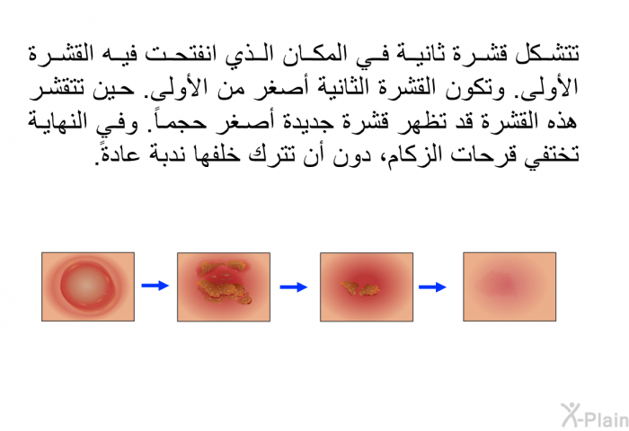 تتشكل قشرة ثانية في المكان الذي انفتحت فيه القشرة الأولى. وتكون القشرة الثانية أصغر من الأولى. حين تتقشر هذه القشرة قد تظهر قشرة جديدة أصغر حجماَ. وفي النهاية تختفي قرحات الزكام، دون أن تترك خلفها ندبة عادة.