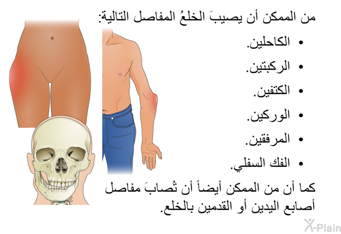 من الممكن أن يصيبَ الخلعُ المفاصل التالية:  الكاحلين الركبتين. الكتفين. الوركين. المرفقين. الفك السفلي.  
 كما أن من الممكن أيضاً أن تُصابَ مفاصل أصابع اليدين أو القدمين بالخلع.