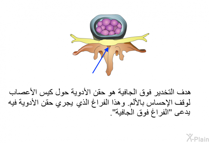 هدف التخدير فوق الجافية هو حقن الأدوية حول كيس الأعصاب لوقف الإحساس بالألم. وهذا الفراغ الذي يجري حقن الأدوية فيه يدعى "الفراغ فوق الجافية".