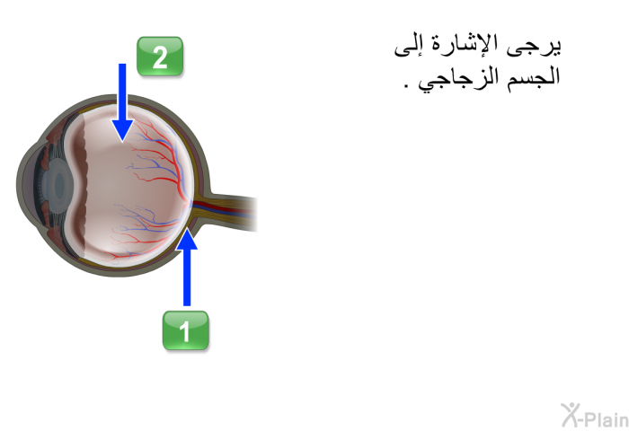 يرجى الإشارة إلى الجسم الزجاجي.