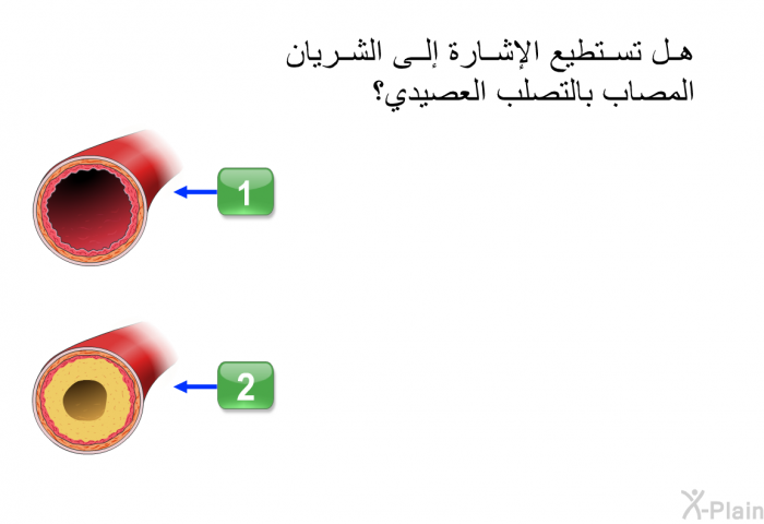 هل تستطيع الإشارة إلى الشريان المصاب بالتصلب العصيدي؟