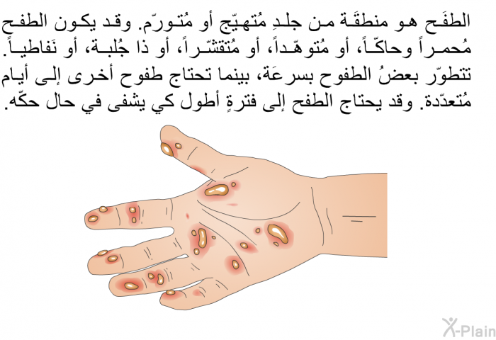 الطفَح هو منطقَة من جلدِ مُتهيّج أو مُتورّم. وقد يكون الطفح مُحمراً وحاكّاً، أو مُتوهّداً، أو مُتقشّراً، أو ذا جُلبة، أو نَفاطياً. تتطوّر بعضُ الطفوح بسرعَة، بينما تحتاج طفوح أخرى إلى أيام مُتعدّدة. وقد يحتاج الطفح إلى فترةٍ أطول كي يشفى في حال حكّه.