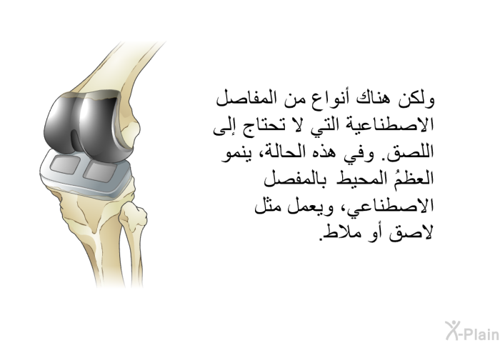 ولكن هناك أنواع من المفاصل الاصطناعية التي لا تحتاج إلى اللصق. وفي هذه الحالة، ينمو العظمُ المحيط بالمفصل الاصطناعي، ويعمل مثل لاصق أو ملاط.