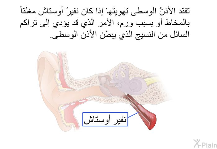 تفقد الأذنُ الوسطى تهويتَها إذا كان نفيرُ أوستاش مغلقاً بالمخاط أو بسبب ورم، الأمر الذي قد يؤدي إلى تراكم السائل من النسيج الذي يبطن الأذن الوسطى.