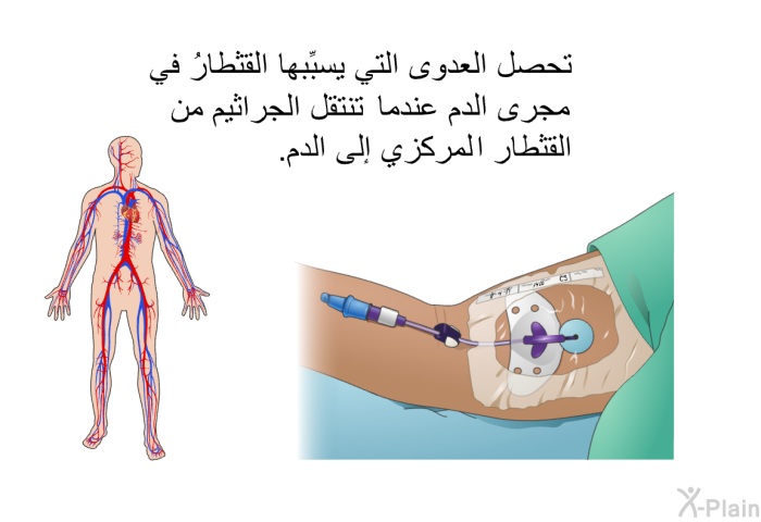 تحصل العدوى التي يسبِّبها القثطارُ في مجرى الدم عندما تنتقل الجراثيم من القثطار المركزي إلى الدم.