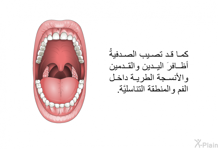 كما قد تصيب الصدفيةُ أظافرَ اليدين والقدمين والأنسجة الطرية داخل الفم والمنطقة التناسليَّة.