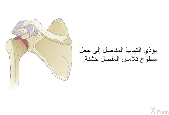 يؤدِّي التهابُ المفاصل إلى جعل سطوح تلامس المفصل خشنة.