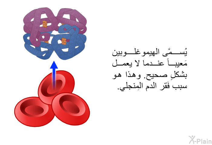 يُسمَّى الهيموغلوبين مَعيباً عندما لا يعمل بشكلٍ صحيح. وهذا هو سبب فَقر الدم المِنجلي.