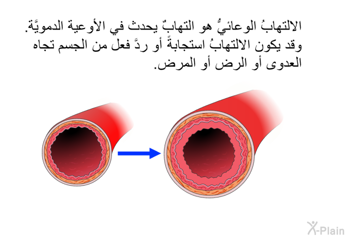 الالتهابُ الوعائيُّ هو التهابٌ يحدث في الأوعية الدمويَّة. وقد يكون الالتهابُ استجابةً أو ردَّ فعل من الجسم تجاه العدوى أو الرضِّ أو المرض.