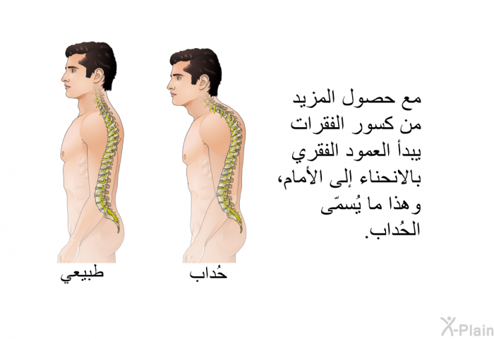 مع حصول المزيد من كسور الفقرات يبدأ العمود الفقري بالانحناء إلى الأمام، وهذا ما يُسمّى الحُداب<B>.</B>