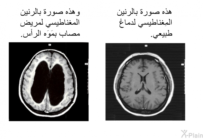 هذه صورةٌ بالرنين المِغناطيسي لدِماغ طبيعي. 
 وهذه صورة بالرنين المغناطيسي لمريض مُصاب بمَوَه الرأس.