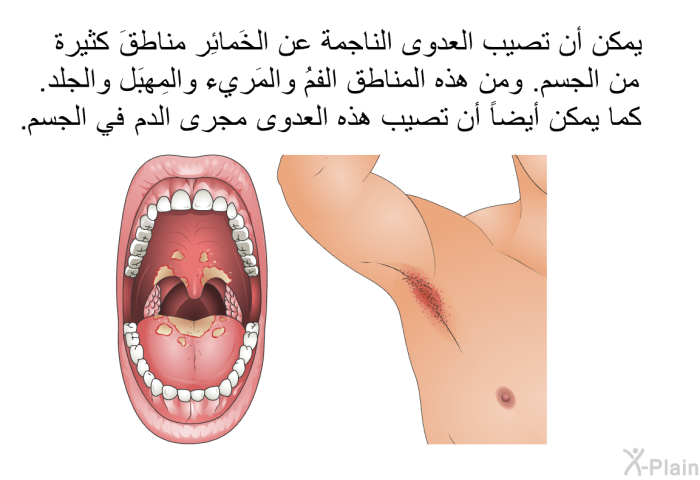 يمكن أن تصيب العدوى الناجمة عن الخَمائِر مناطقَ كثيرة من الجسم. ومن هذه المناطق الفمُ والمَريء والمَهبِل والجلد. كما يمكن أيضاً أن تصيب هذه العدوى مجرى الدم في الجسم.