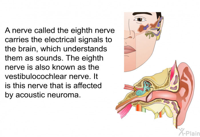 A nerve called the eighth nerve carries the electrical signals to the brain, which understands them as sounds. The eighth nerve is also known as the vestibulocochlear nerve. It is this nerve that is affected by acoustic neuroma.