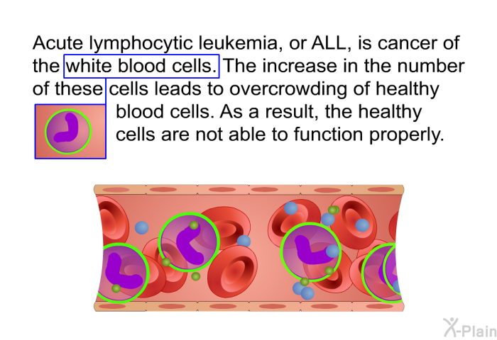 Acute lymphocytic leukemia, or ALL, is cancer of the white blood cells. The increase in the number of these cells leads to overcrowding of healthy blood cells. As a result, the healthy cells are not able to function properly.