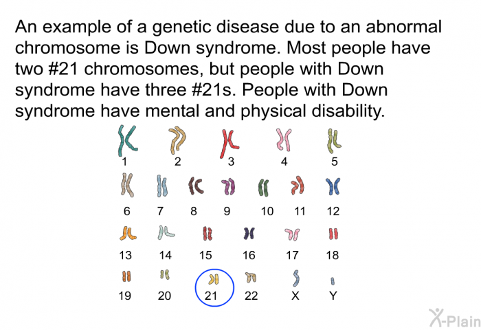 An example of a genetic disease due to an abnormal chromosome is Down syndrome. Most people have two #21 chromosomes, but people with Down syndrome have three #21s. People with Down syndrome have mental and physical disability.