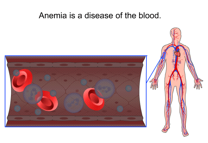 Anemia is a disease of the blood.