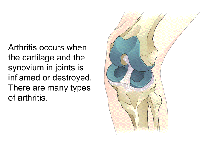 Arthritis occurs when the cartilage and the synovium in joints is inflamed or destroyed. There are many types of arthritis.