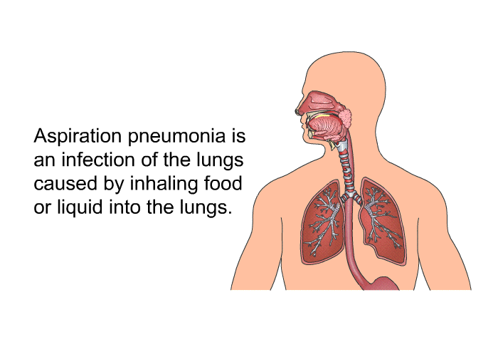Aspiration pneumonia is an infection of the lungs caused by inhaling food or liquid into the lungs.
