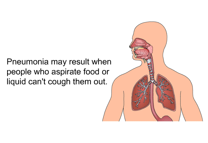 Pneumonia may result when people who aspirate food or liquid can't cough them out.