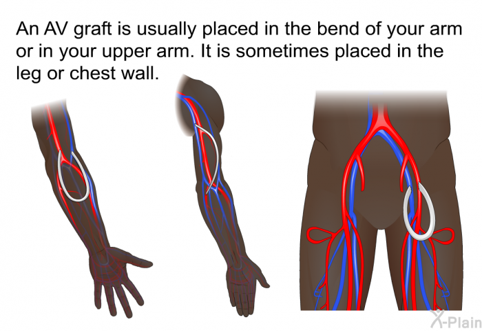 An AV graft is usually placed in the bend of your arm or in your upper arm. It is sometimes placed in the leg or chest wall.