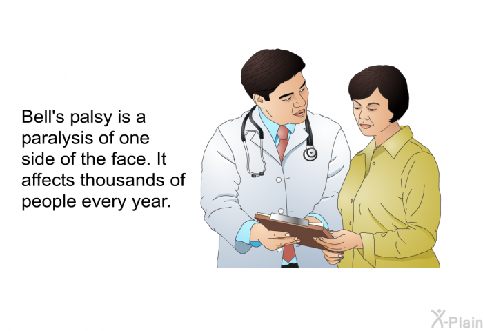 Bell's palsy is a paralysis of one side of the face. It affects thousands of people every year.