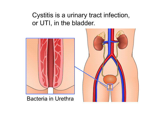 Cystitis is a urinary tract infection, or UTI, in the bladder.