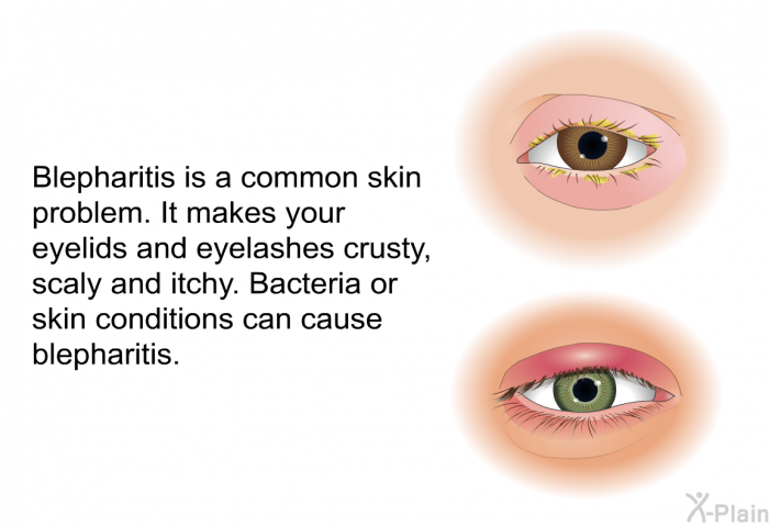 Blepharitis is a common skin problem. It makes your eyelids and eyelashes crusty, scaly and itchy. Bacteria or skin conditions can cause blepharitis.