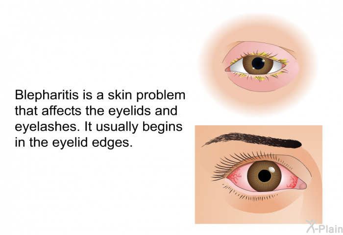 Blepharitis is a skin problem that affects the eyelids and eyelashes. It usually begins in the eyelid edges.