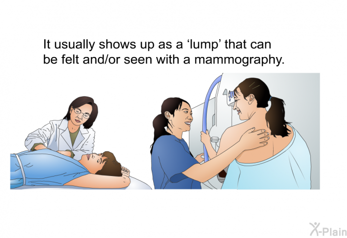 It usually shows up as a  lump' that can be felt and/or seen with a mammography.