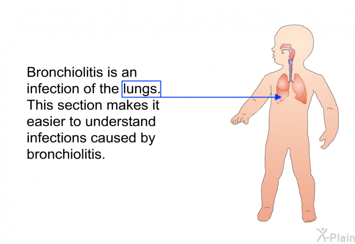 Bronchiolitis is an infection of the lungs. This section makes it easier to understand infections caused by bronchiolitis.