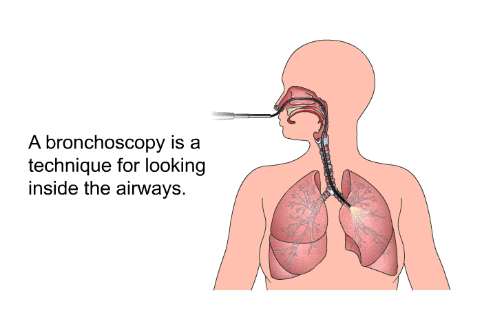 A bronchoscopy is a technique for looking inside the airways.
