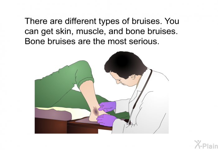 There are different types of bruises. You can get skin, muscle, and bone bruises. Bone bruises are the most serious.