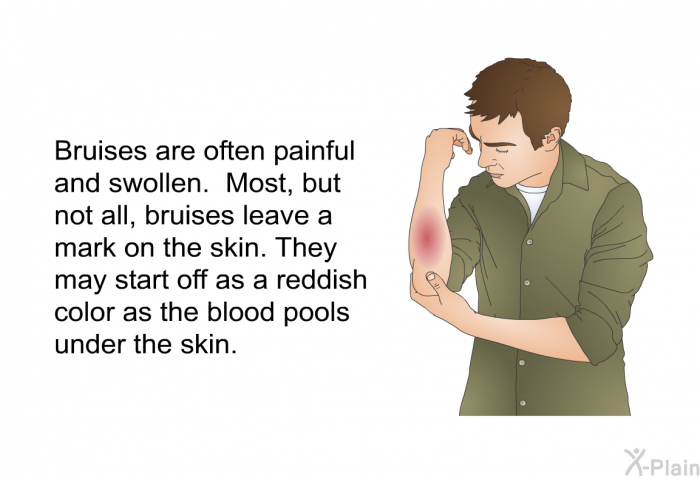 Bruises are often painful and swollen. Most, but not all, bruises leave a mark on the skin. They may start off as a reddish color as the blood pools under the skin.