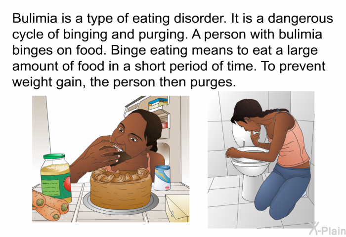 Bulimia is a type of eating disorder. It is a dangerous cycle of binging and purging. A person with bulimia binges on food. Binge eating means to eat a large amount of food in a short period of time. To prevent weight gain, the person then purges.