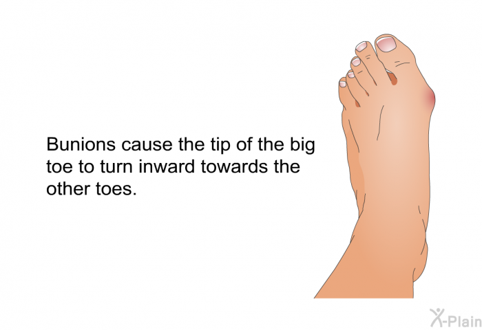 Bunions cause the tip of the big toe to turn inward towards the other toes.