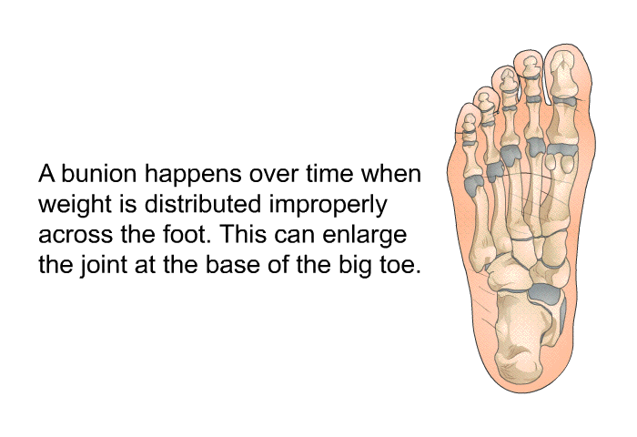 A bunion happens over time when weight is distributed improperly across the foot. This can enlarge the joint at the base of the big toe.