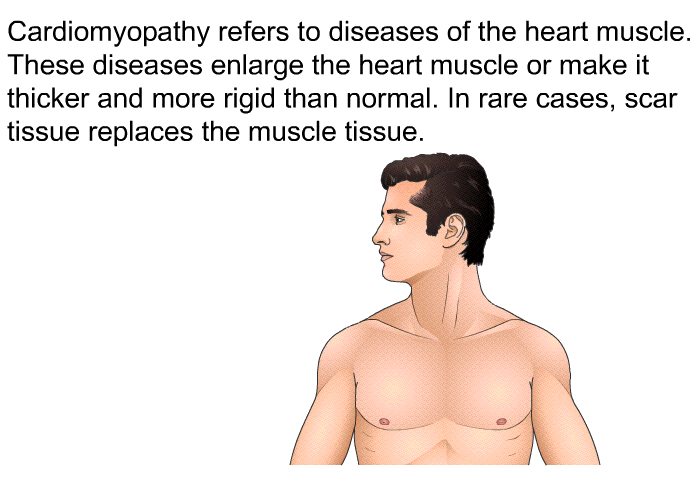 Cardiomyopathy refers to diseases of the heart muscle. These diseases enlarge the heart muscle or make it thicker and more rigid than normal. In rare cases, scar tissue replaces the muscle tissue.