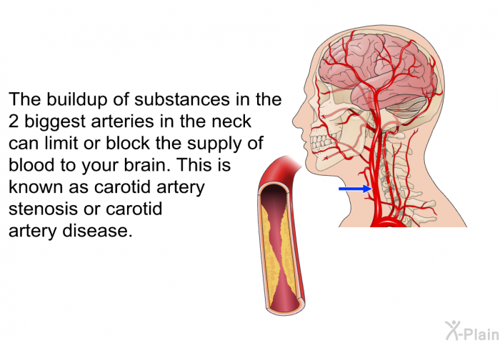 The buildup of substances in the 2 biggest arteries in the neck can limit or block the supply of blood to your brain. This is known as carotid artery stenosis or carotid artery disease.