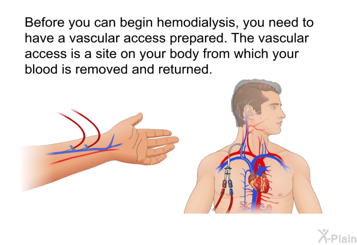 Before you can begin hemodialysis, you need to have a vascular access prepared. The vascular access is a site on your body from which your blood is removed and returned.