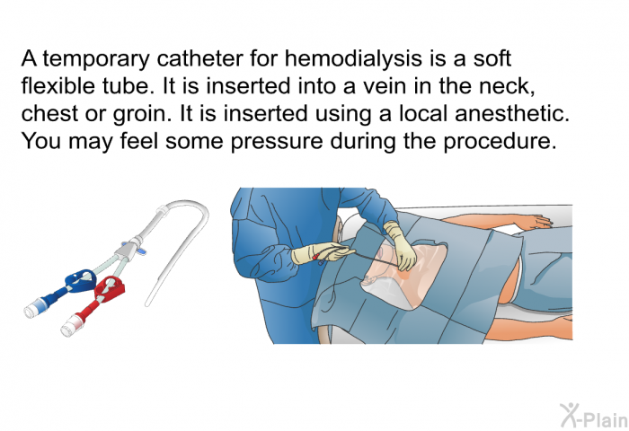 A temporary catheter for hemodialysis is a soft flexible tube. It is inserted into a vein in the neck, chest or groin. It is inserted using a local anesthetic. You may feel some pressure during the procedure.