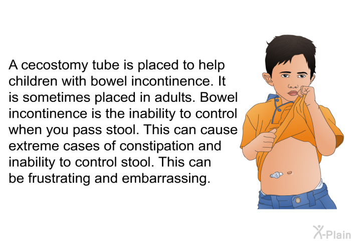 A cecostomy tube is placed to help children with bowel incontinence. It is sometimes placed in adults. Bowel incontinence is the inability to control when you pass stool. This can cause extreme cases of constipation and inability to control stool. This can be frustrating and embarrassing.